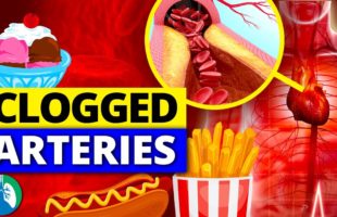❣️Top 10 WORST Foods that CLOG Your Arteries (NEVER EAT THIS)